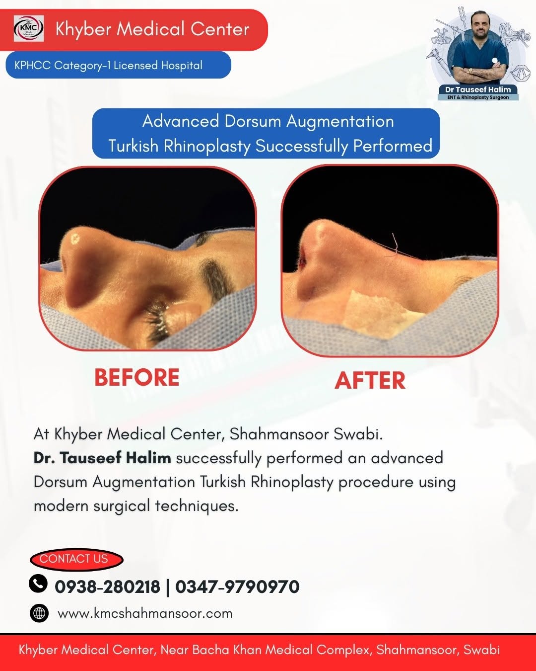 Advanced Dorsum Augmentation Turkish Rhinoplasty Successfully Performed

At Khyber Medical Center, Shahmansoor Swabi,
Dr. Tauseef Halim successfully performed an advanced Dorsum Augmentation Turkish Rhinoplasty procedure using modern surgical techniques.
Natural Shape | Better Facial Harmony | Advanced Surgical Care
📞 For Appointments & Details:
0938-280218 | 0347-9790970
📍 Khyber Medical Center, Shahmansoor, Swabi